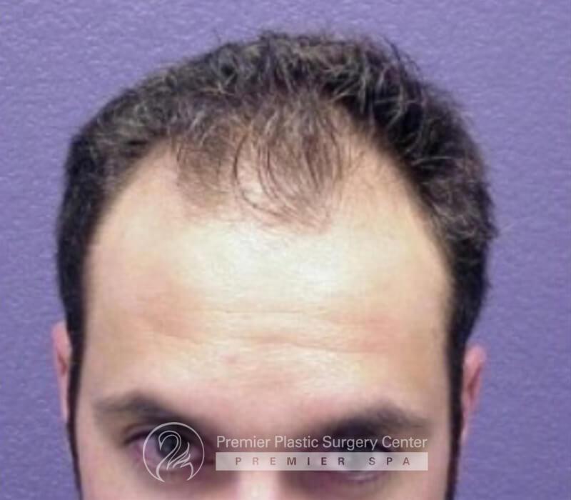 Neograft Hair Transplant Before & After Image