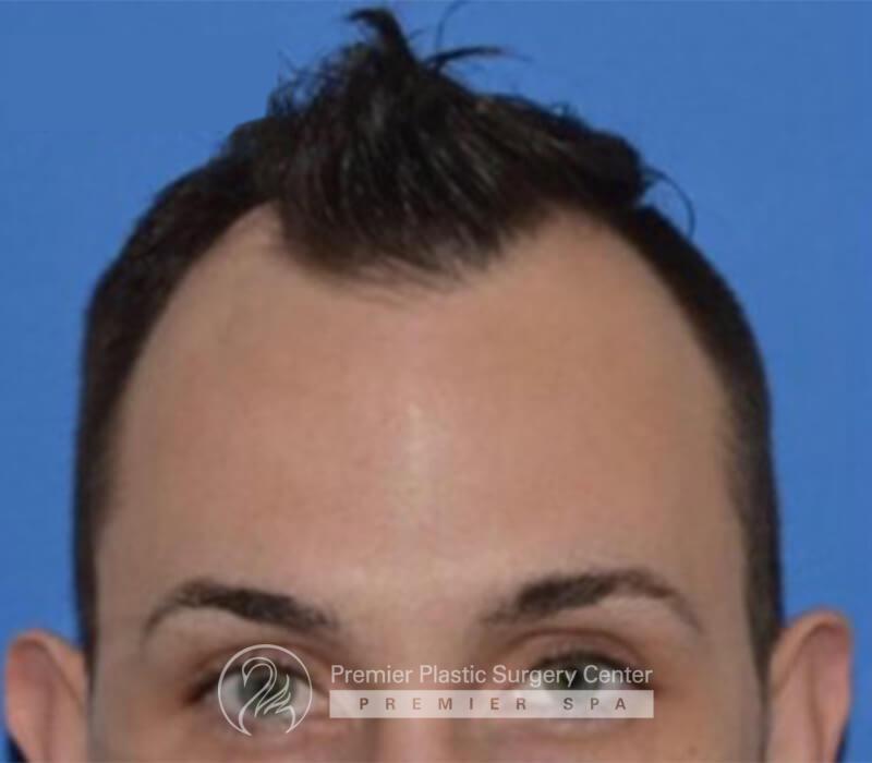 Neograft Hair Transplant Before & After Image