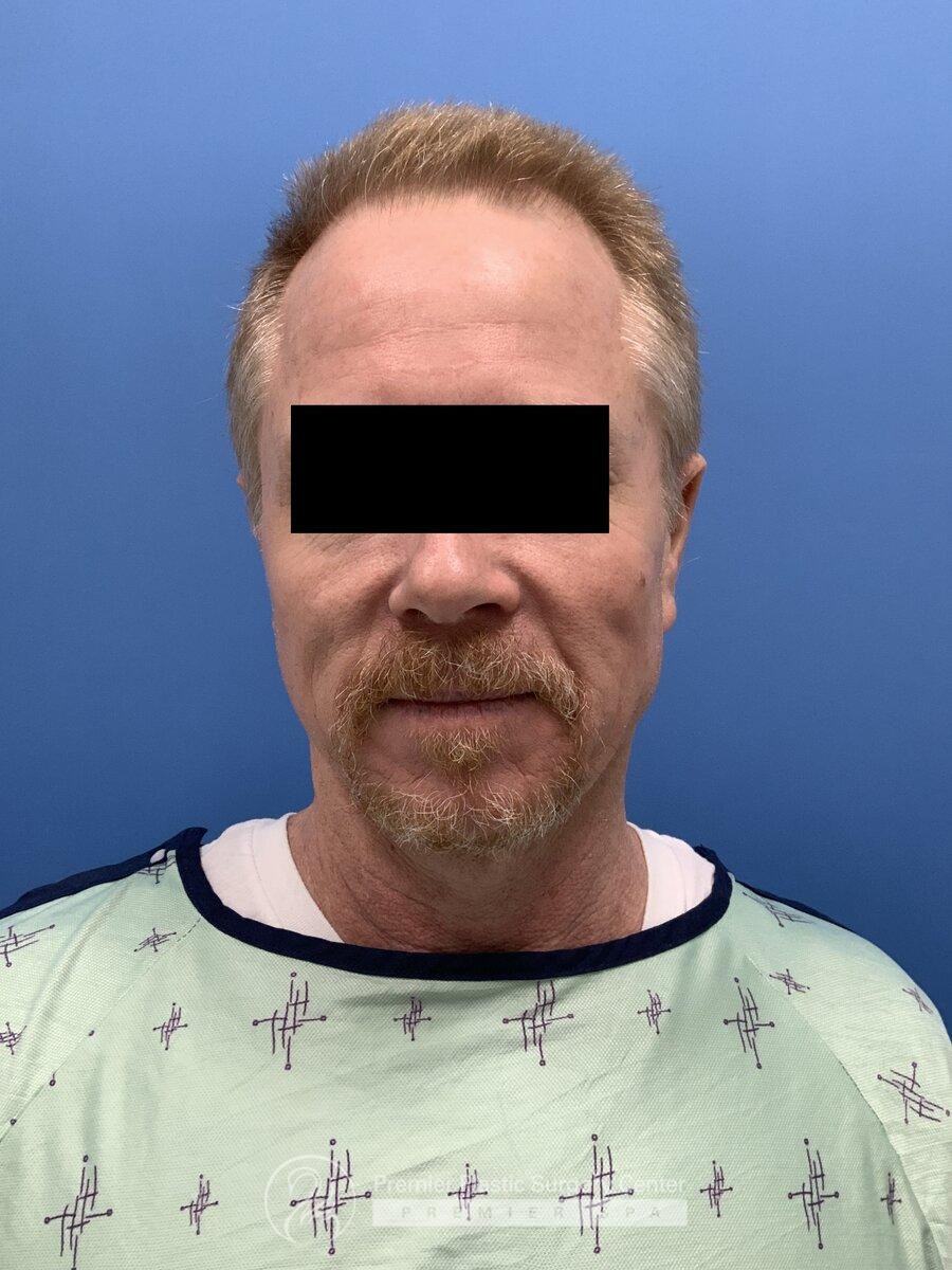 Neograft Hair Transplant Before & After Image
