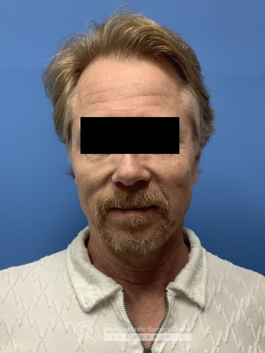 Neograft Hair Transplant Before & After Image
