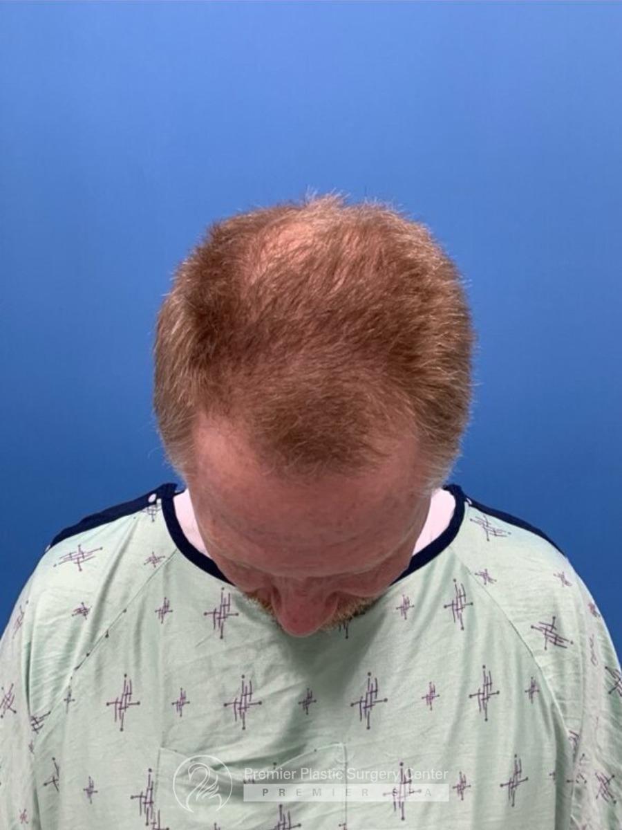 Neograft Hair Transplant Before & After Image