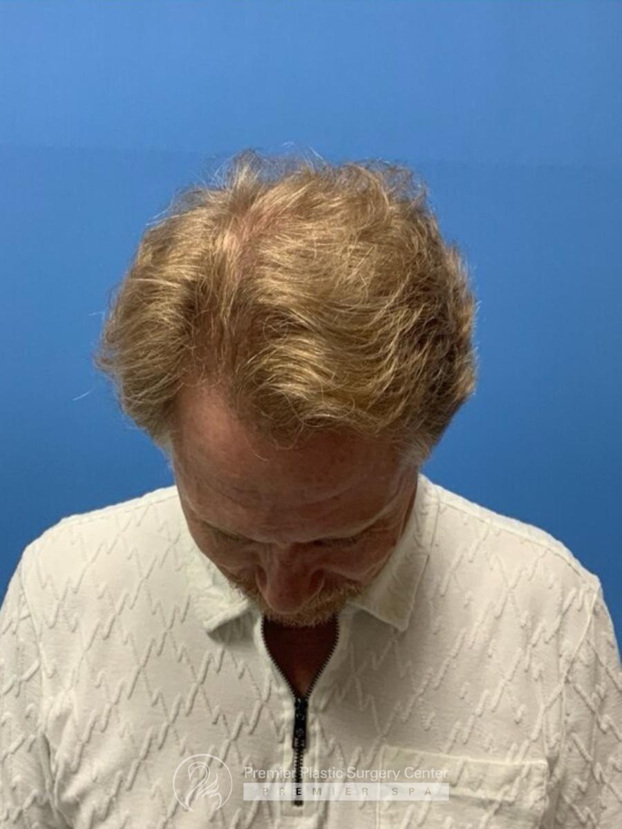 Neograft Hair Transplant Before & After Image