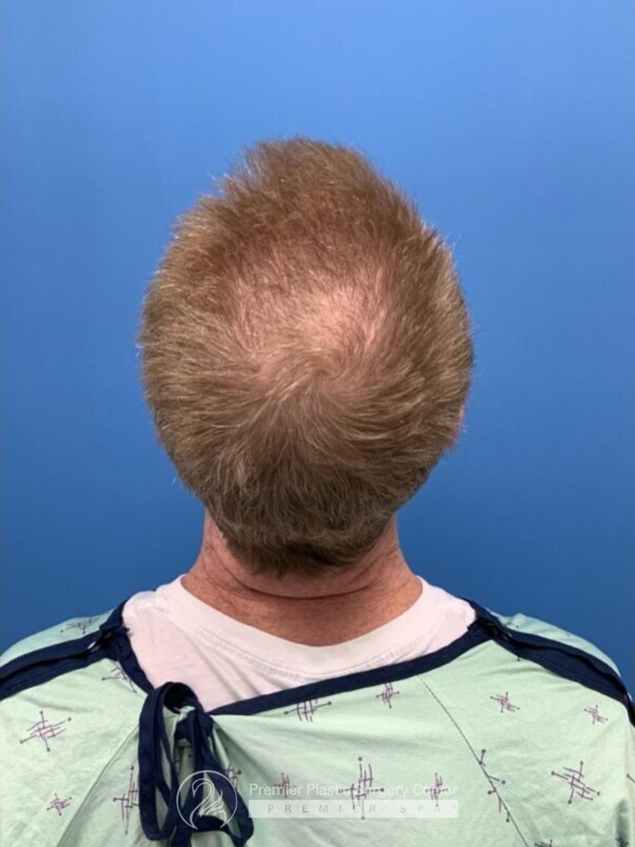 Neograft Hair Transplant Before & After Image
