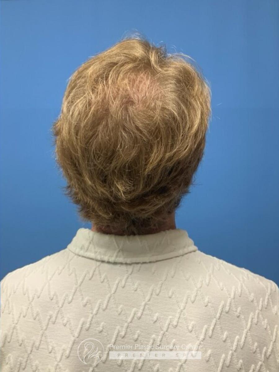 Neograft Hair Transplant Before & After Image