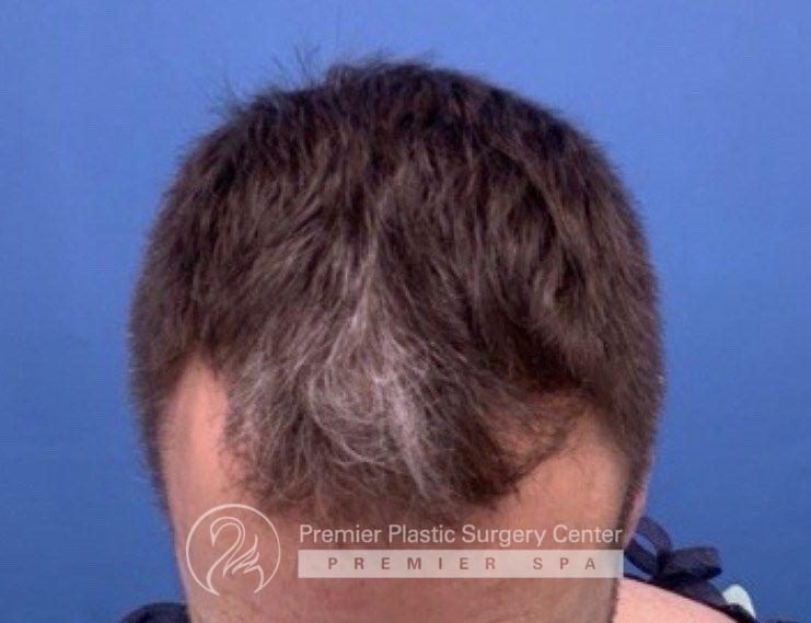 Neograft Hair Transplant Before & After Image