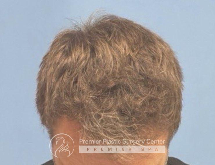 Neograft Hair Transplant Before & After Image