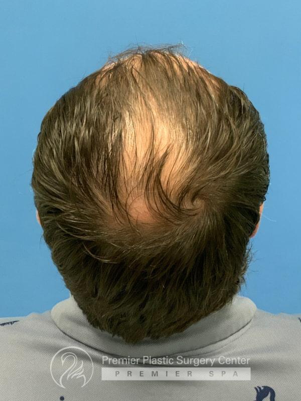 Non-Surgical Hair Restoration Before & After Image