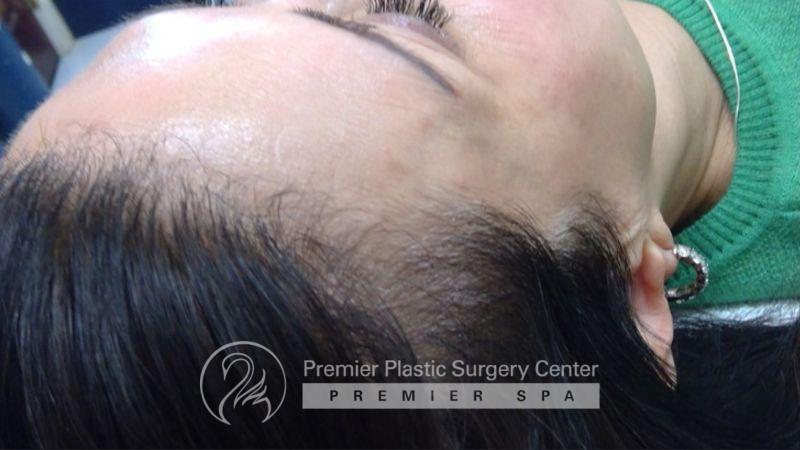 Non-Surgical Hair Restoration Before & After Image