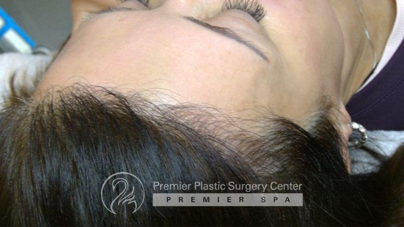 Non-Surgical Hair Restoration Before & After Image