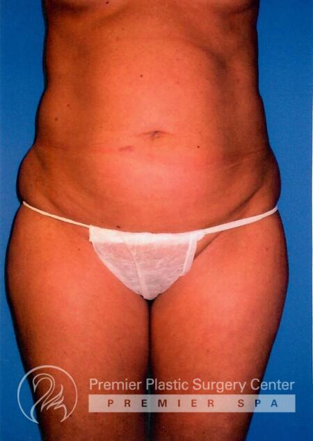 Premier Plastic Surgery Center Before & After Image