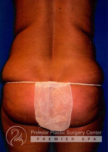 Premier Plastic Surgery Center Before & After Image