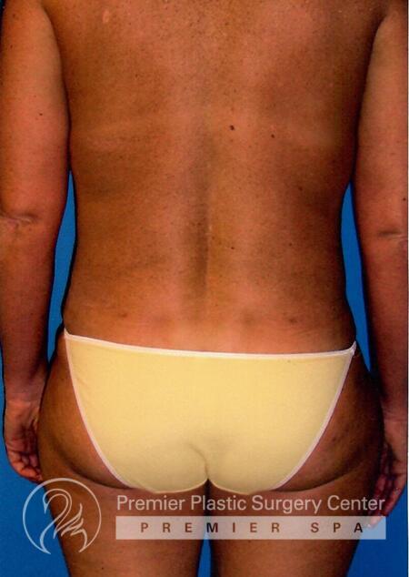 Premier Plastic Surgery Center Before & After Image