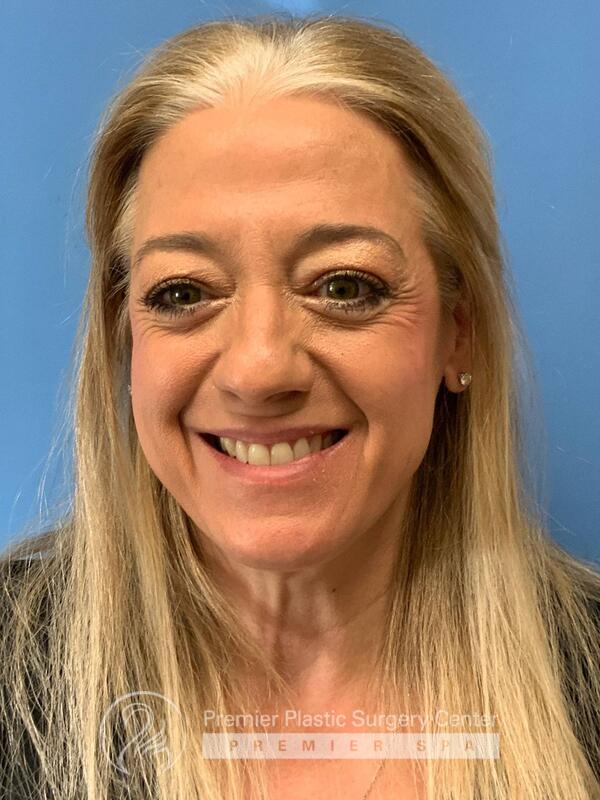 Botox Before & After Image