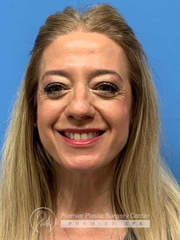 Botox Before & After Image