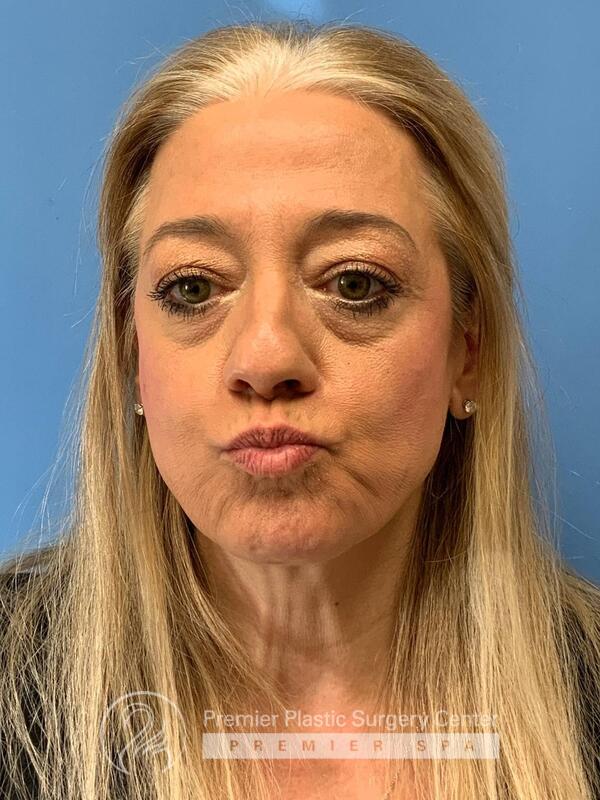Botox Before & After Image