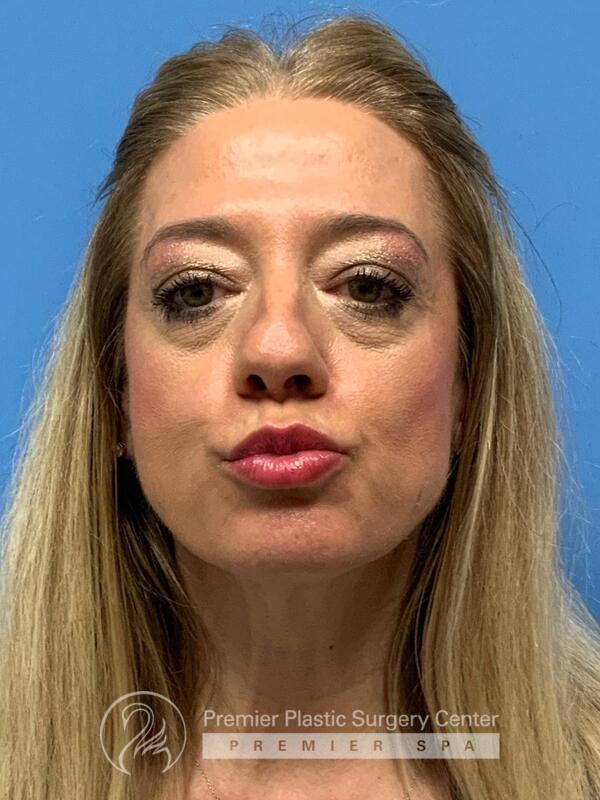 Botox Before & After Image