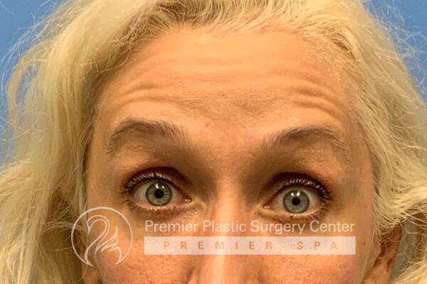 Botox Before & After Image