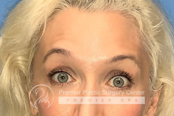 Botox Before & After Image