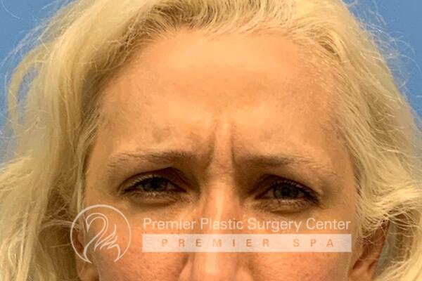 Botox Before & After Image
