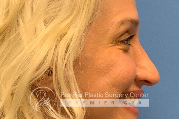Botox Before & After Image
