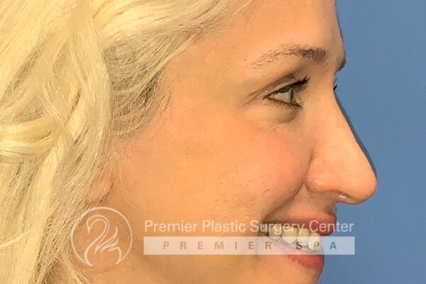 Botox Before & After Image