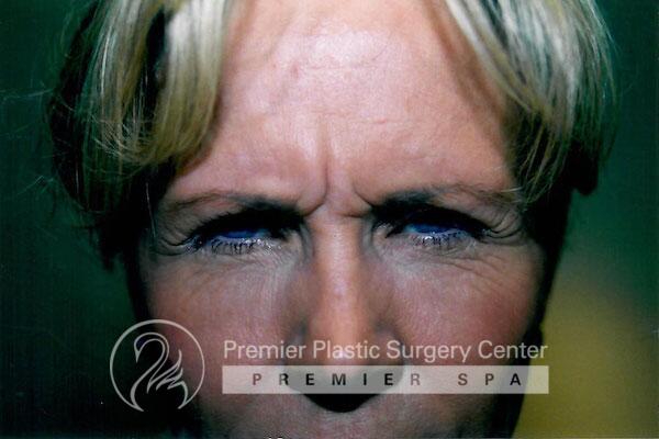 Botox Before & After Image