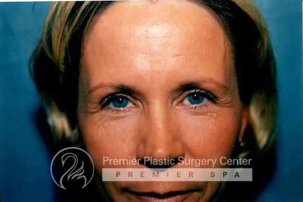 Botox Before & After Image