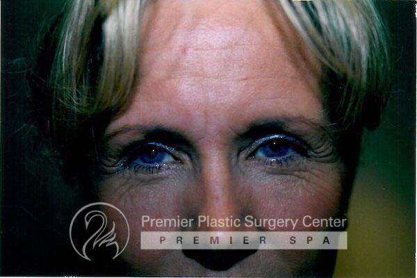 Botox Before & After Image