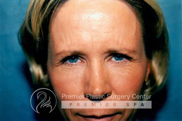 Botox Before & After Image