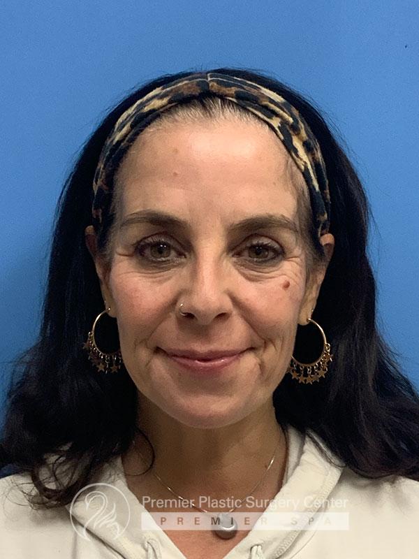 Botox Before & After Image