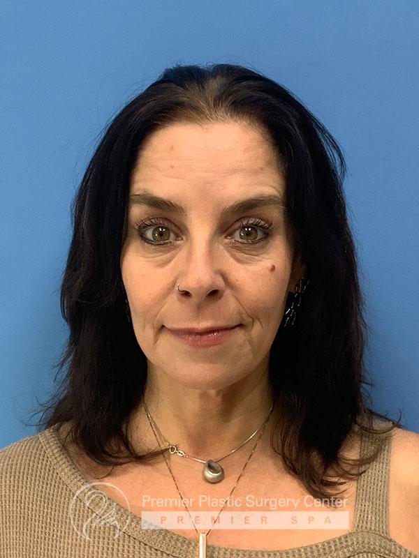 Botox Before & After Image