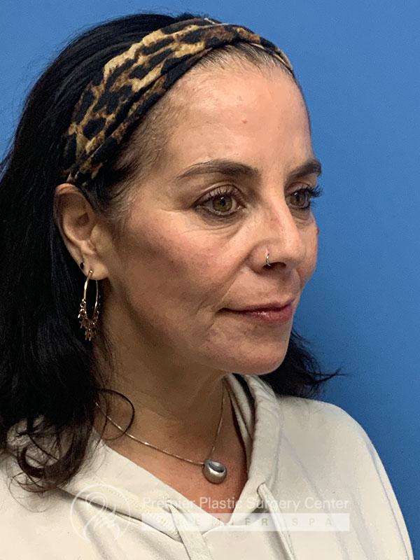 Botox Before & After Image