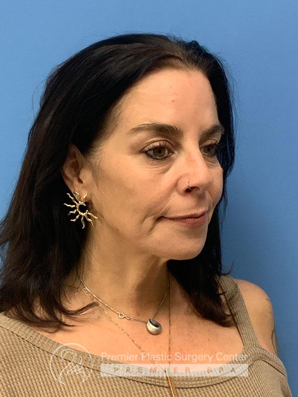 Botox Before & After Image