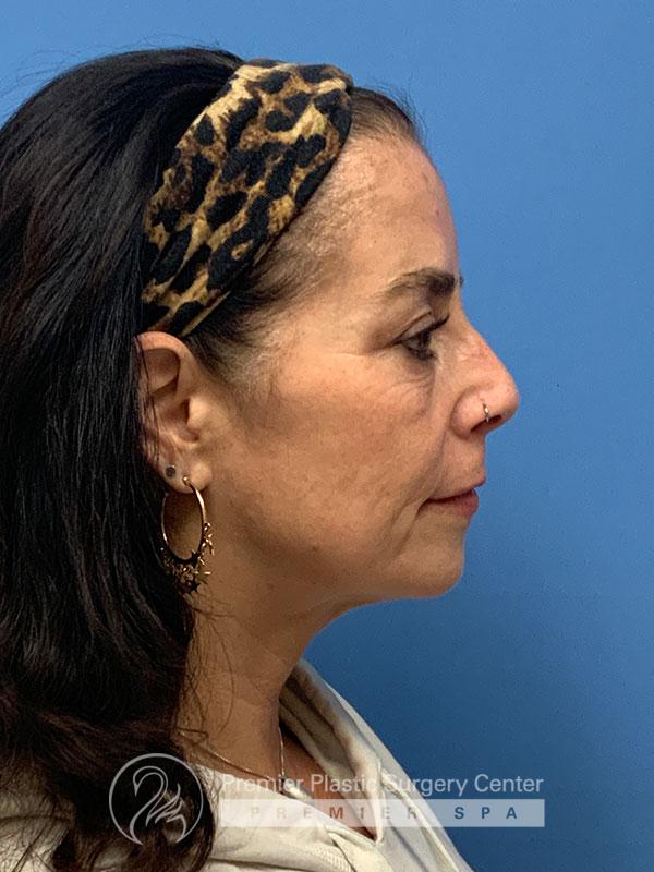 Botox Before & After Image