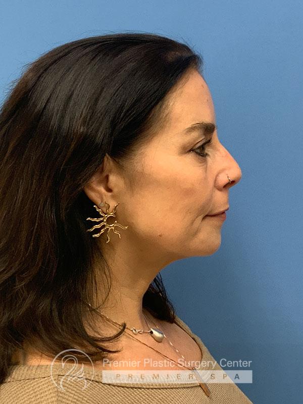 Botox Before & After Image