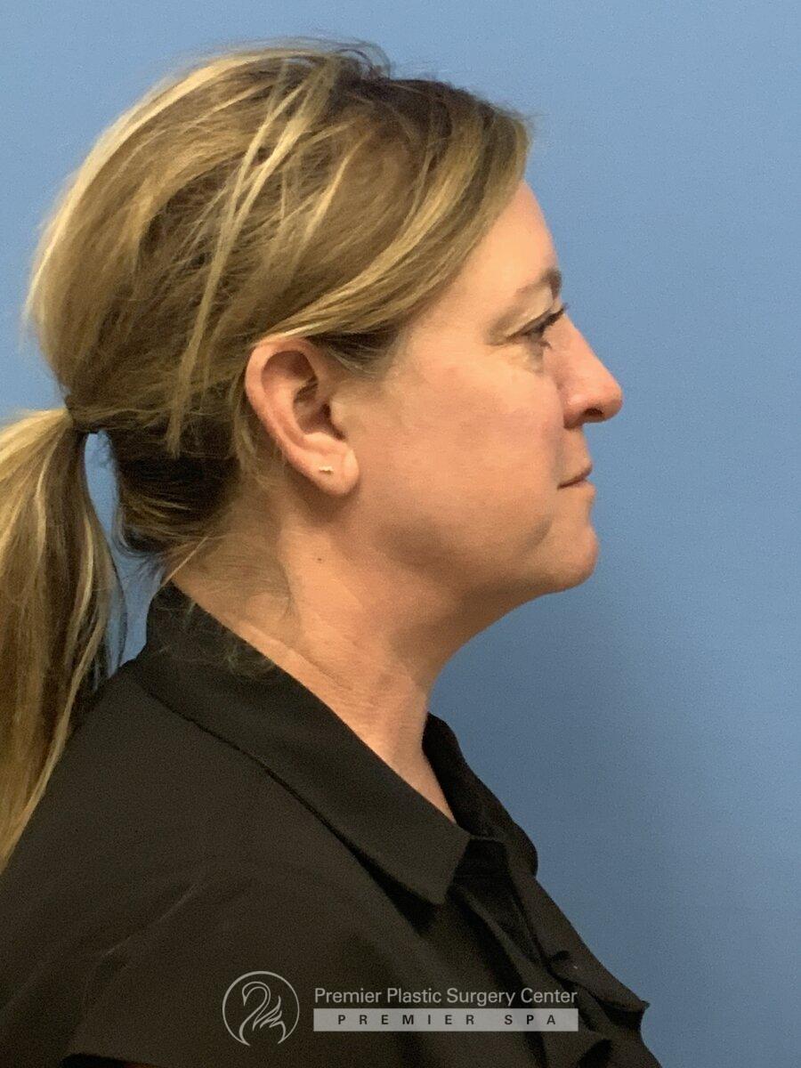 Botox Before & After Image