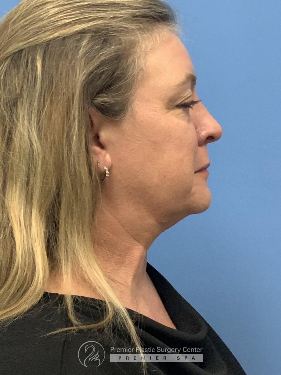 Botox Before & After Image