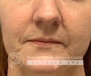 Fillers Before & After Image