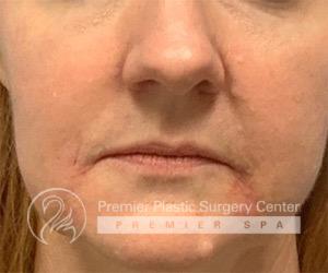 Fillers Before & After Image