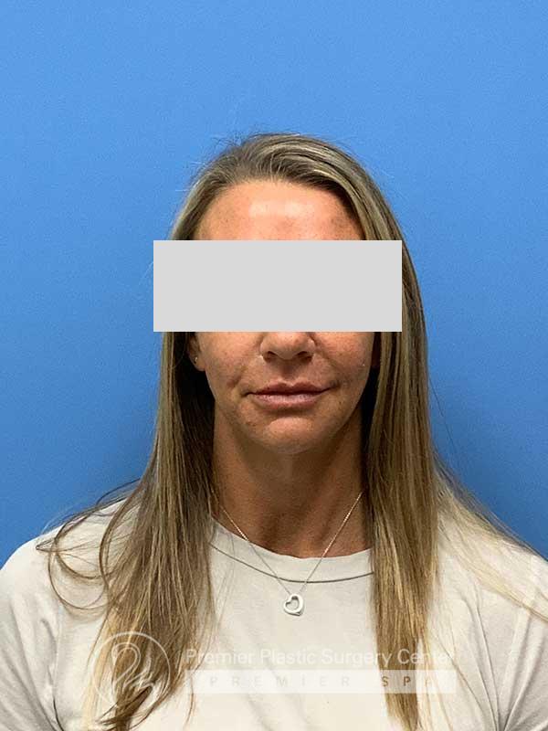 Fillers Before & After Image