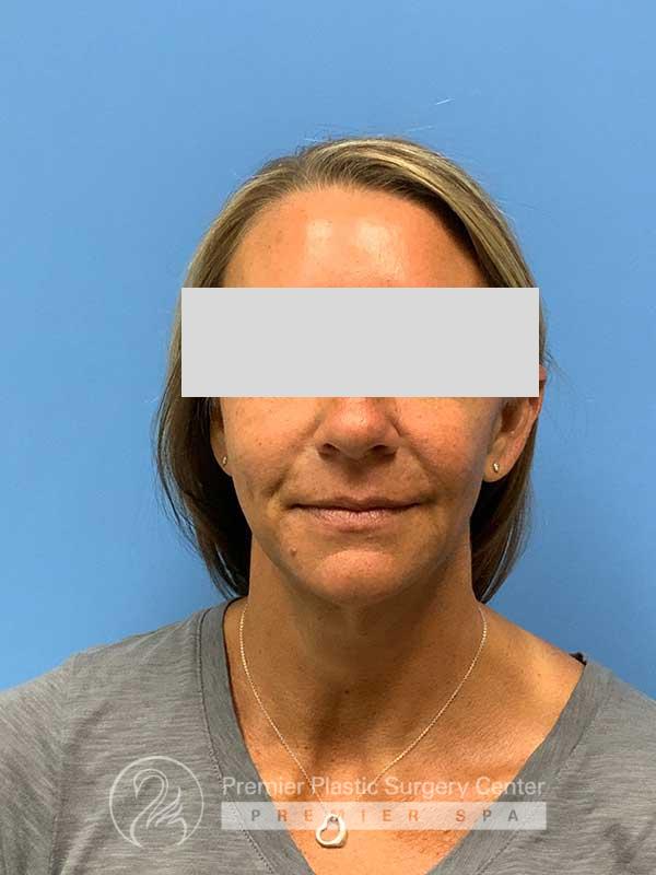 Fillers Before & After Image