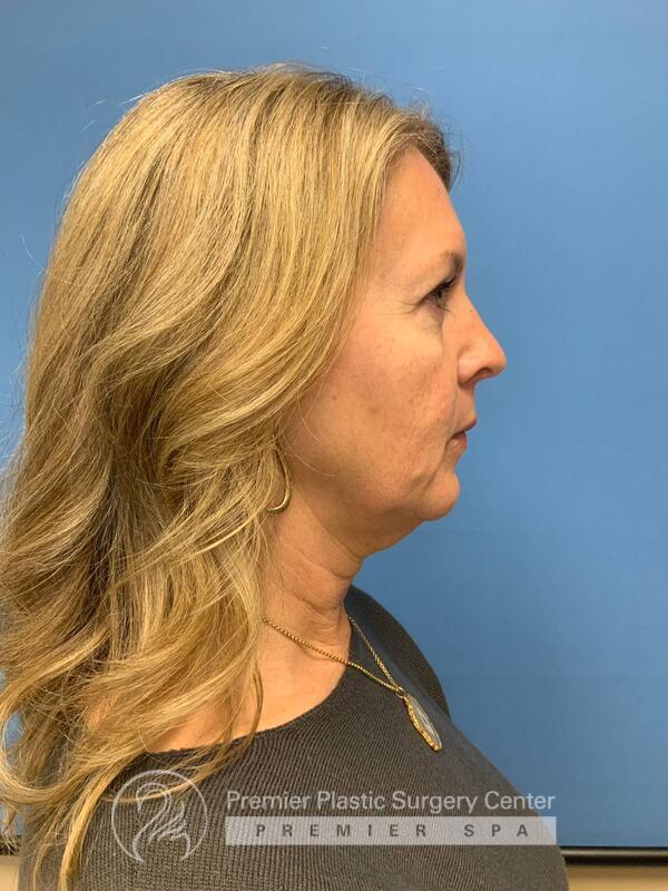 Fillers Before & After Image