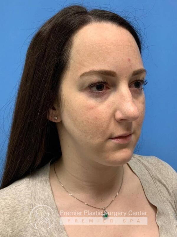 Fillers Before & After Image
