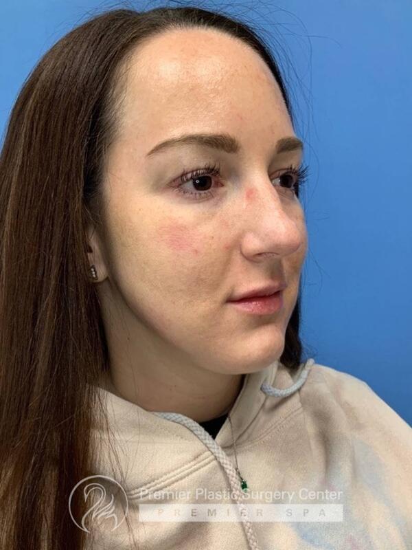 Fillers Before & After Image