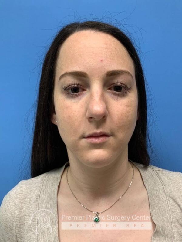 Fillers Before & After Image