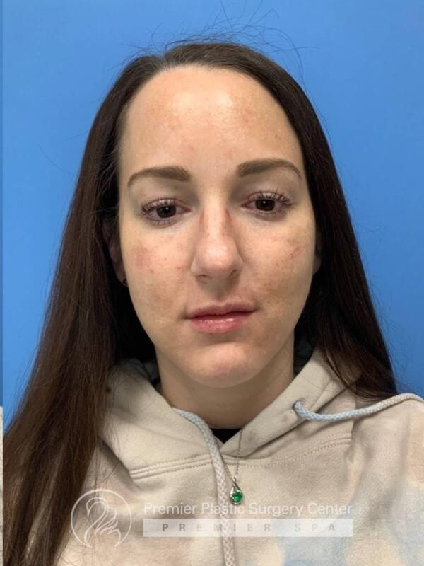 Fillers Before & After Image