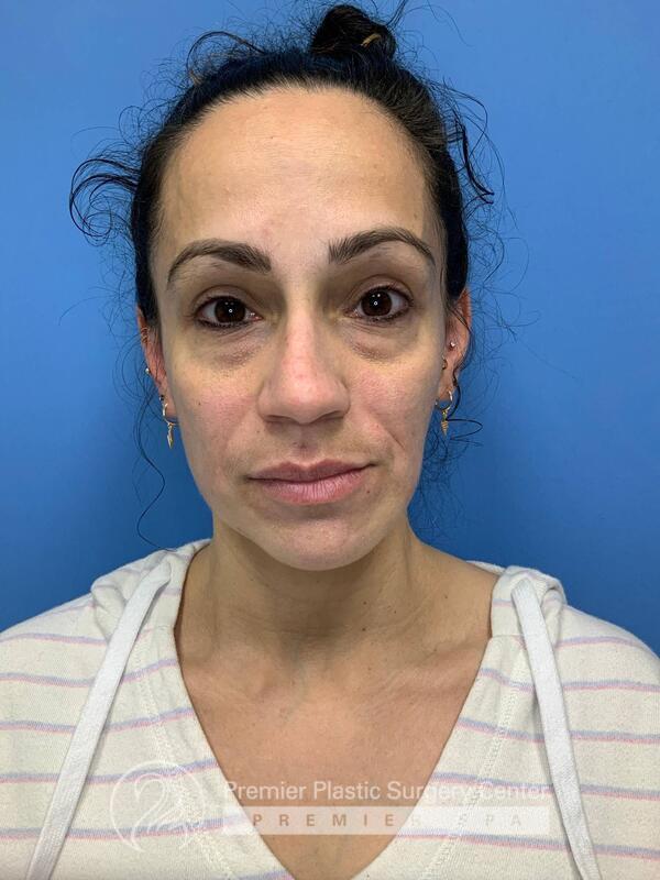 Fillers Before & After Image