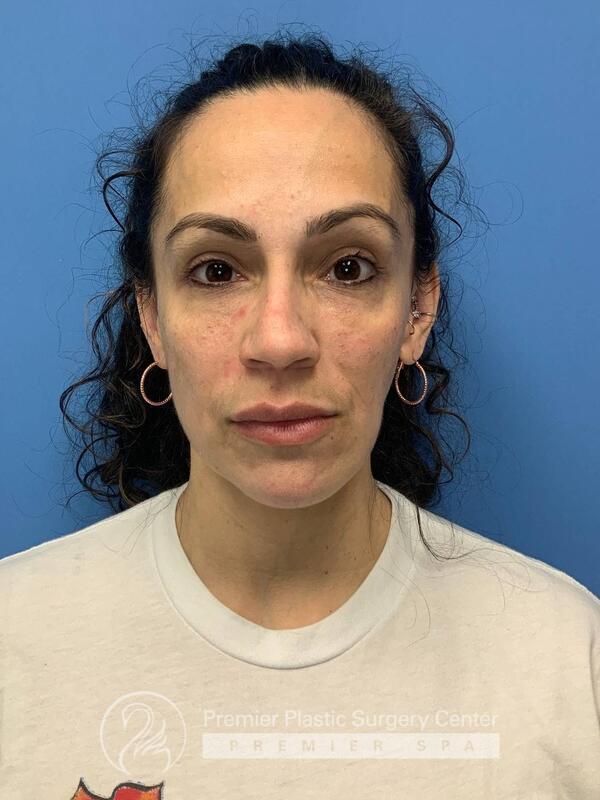 Fillers Before & After Image