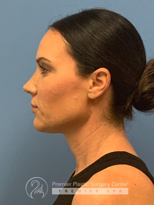 Fillers Before & After Image