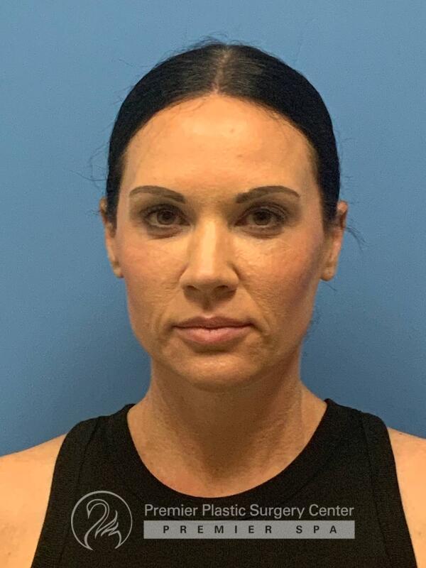 Fillers Before & After Image